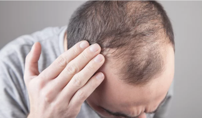 Malattie che provocano la caduta dei capelli